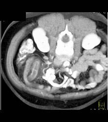 Acute Appendicitis and Ovarian Cyst - CTisus CT Scan