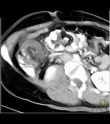 Acute Appendicitis and Ovarian Cyst - CTisus CT Scan