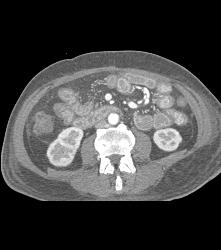 Radiation Enteritis - CTisus CT Scan