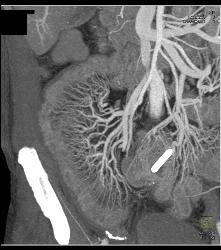 Radiation Enteritis - CTisus CT Scan