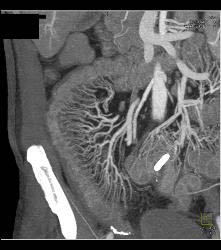 Radiation Enteritis - CTisus CT Scan