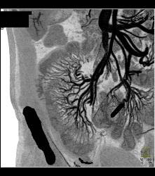 Radiation Enteritis - CTisus CT Scan