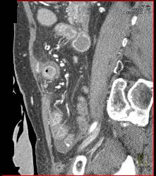 Radiation Enteritis - CTisus CT Scan