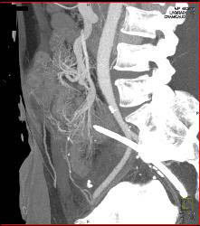 Radiation Enteritis - CTisus CT Scan