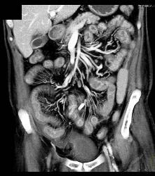 Radiation Enteritis - CTisus CT Scan