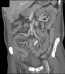 Radiation Enteritis - CTisus CT Scan