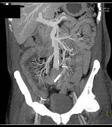 Radiation Enteritis - CTisus CT Scan