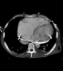 Poor Cardiac Function and Incidental Angiosarcoma of Mesentery - CTisus CT Scan