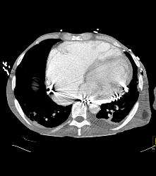 Poor Cardiac Function and Incidental Angiosarcoma of Mesentery - CTisus CT Scan