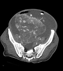 Poor Cardiac Function and Incidental Angiosarcoma of Mesentery - CTisus CT Scan