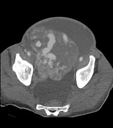 Poor Cardiac Function and Incidental Angiosarcoma of Mesentery - CTisus CT Scan