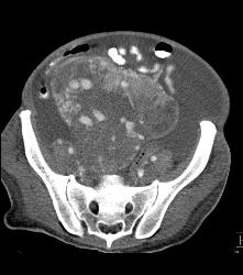 Poor Cardiac Function and Incidental Angiosarcoma of Mesentery - CTisus CT Scan