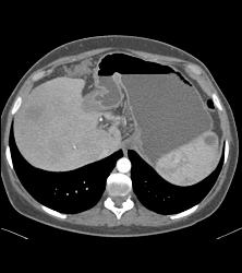 Hemangiomatosis in Klippel-Trenaunay-Weber (KTW) Syndrome - CTisus CT Scan