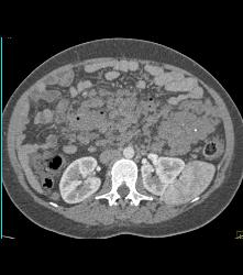 Hemangiomatosis in Klippel-Trenaunay-Weber (KTW) Syndrome - CTisus CT Scan