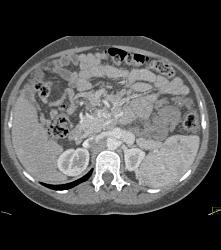 Hemangiomatosis in Klippel-Trenaunay-Weber (KTW) Syndrome - CTisus CT Scan