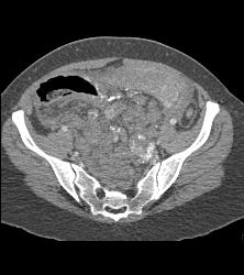 Hemangiomatosis in Klippel-Trenaunay-Weber (KTW) Syndrome - CTisus CT Scan