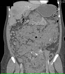 Hemangiomatosis in Klippel-Trenaunay-Weber (KTW) Syndrome - CTisus CT Scan