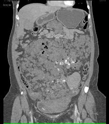 Hemangiomatosis in Klippel-Trenaunay-Weber (KTW) Syndrome - CTisus CT Scan