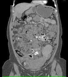 Hemangiomatosis in Klippel-Trenaunay-Weber (KTW) Syndrome - CTisus CT Scan