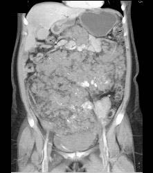 Hemangiomatosis in Klippel-Trenaunay-Weber (KTW) Syndrome - CTisus CT Scan