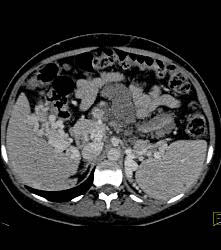 Hemangiomatosis in Klippel-Trenaunay-Weber (KTW) Syndrome - CTisus CT Scan