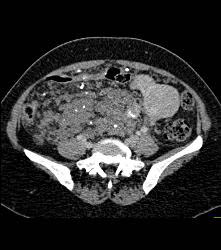 Hemangiomatosis in Klippel-Trenaunay-Weber (KTW) Syndrome - CTisus CT Scan