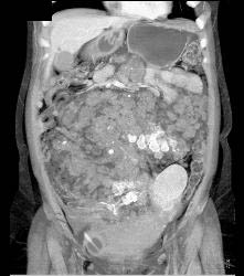 Hemangiomatosis in Klippel-Trenaunay-Weber (KTW) Syndrome - CTisus CT Scan