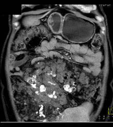 Hemangiomatosis in Klippel-Trenaunay-Weber (KTW) Syndrome - CTisus CT Scan