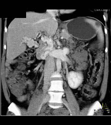 Hemangiomatosis in Klippel-Trenaunay-Weber (KTW) Syndrome - CTisus CT Scan