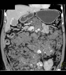 Hemangiomatosis in Klippel-Trenaunay-Weber (KTW) Syndrome - CTisus CT Scan