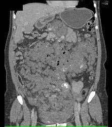 Hemangiomatosis in Klippel-Trenaunay-Weber (KTW) Syndrome - CTisus CT Scan