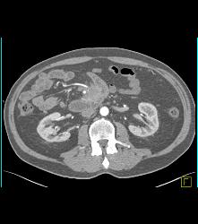 Carcinoid Tumor - CTisus CT Scan