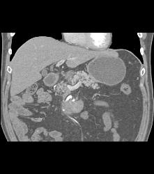 Carcinoid Tumor - CTisus CT Scan