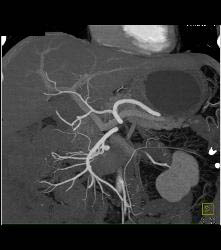 Carcinoid Tumor - CTisus CT Scan