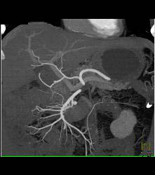 Carcinoid Tumor - CTisus CT Scan