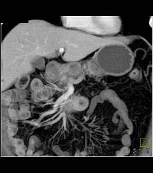 Carcinoid Tumor - CTisus CT Scan