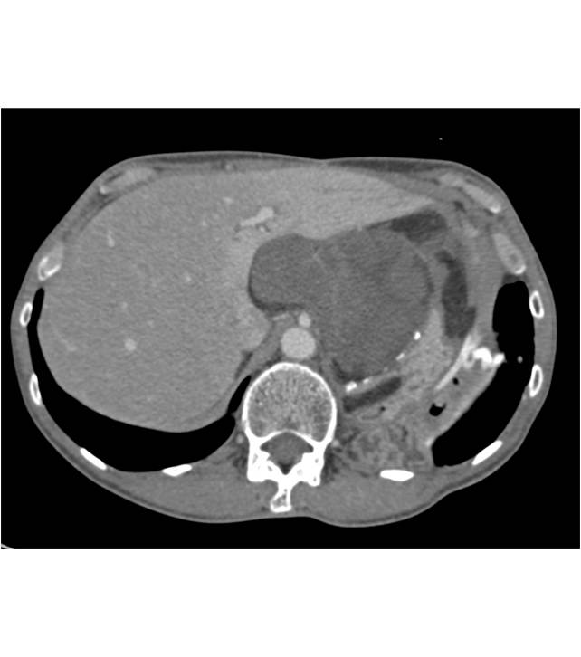 Retroperitoneal Liposarcoma - CTisus CT Scan