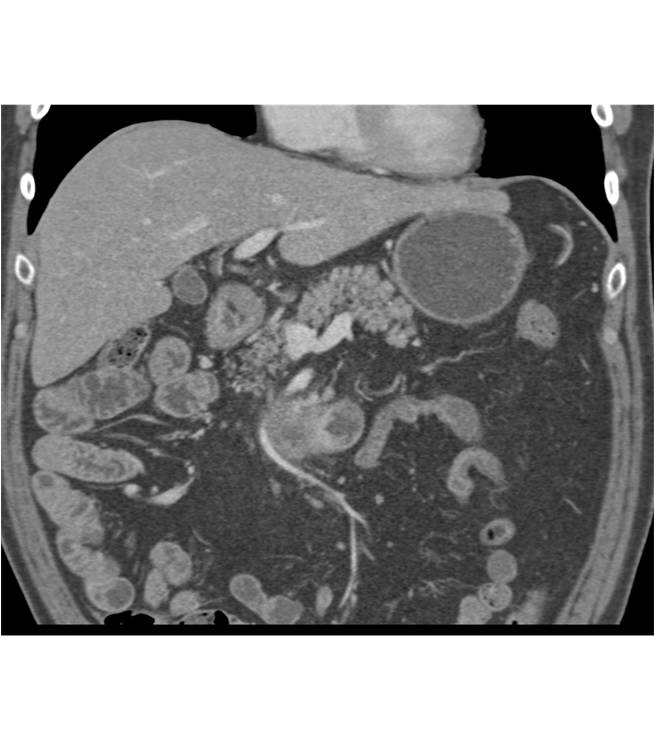 Duodenal Carcinoma - CTisus CT Scan