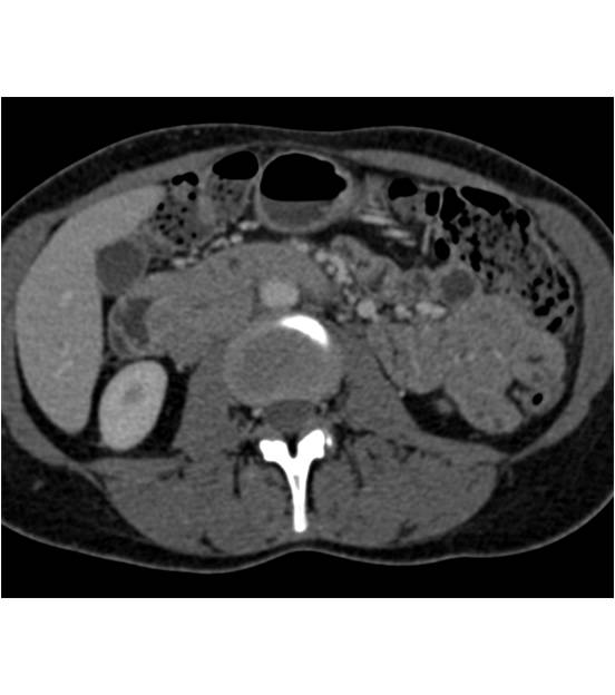 GIST Tumor in the Duodenum - CTisus CT Scan