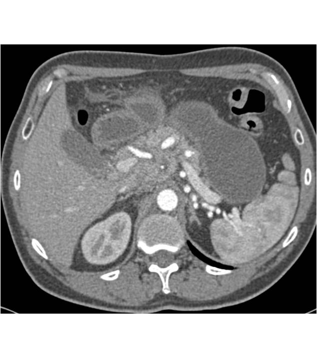 Small Bowel Lymphoma with Adenopathy - CTisus CT Scan