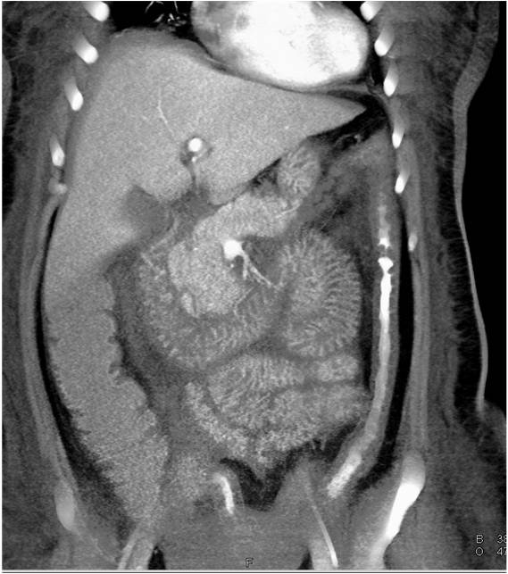 Edematous Changes in the Small Bowel - CTisus CT Scan