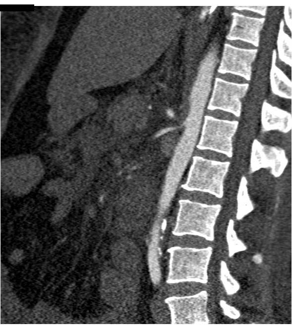 Low Flow State to Small Bowel with Small Celiac and SMA - CTisus CT Scan