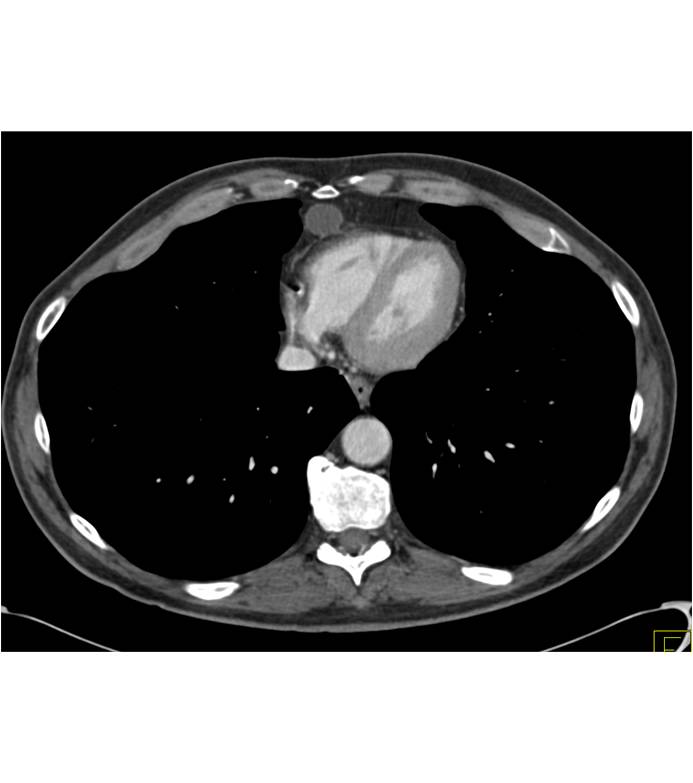 Metastatic Melanoma to Muscle, Nodes, Bowel and Omentum - CTisus CT Scan