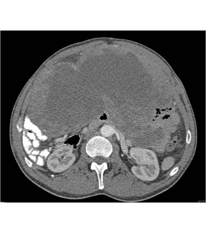 Mesothelioma of the Abdomen - CTisus CT Scan