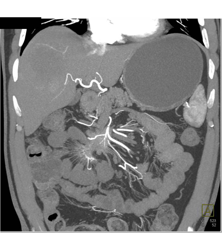 Carcinoid Tumor in the Root of the Mesentery with Desmoplastic Reaction - CTisus CT Scan