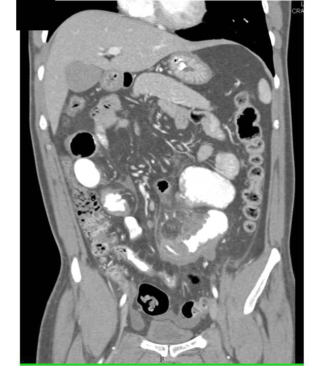 Crohn's Disease - CTisus CT Scan