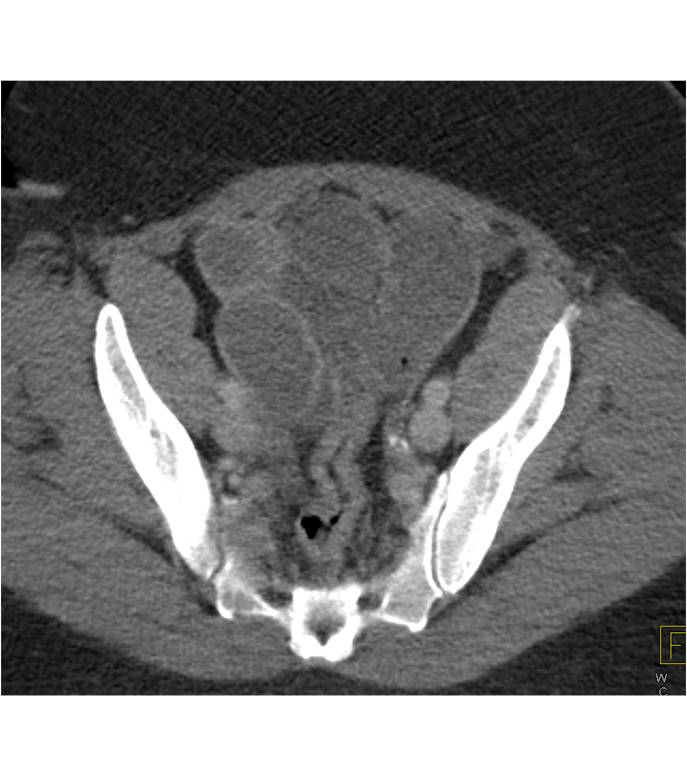 Small Bowel Obstruction due to Midgut Volvulus - CTisus CT Scan