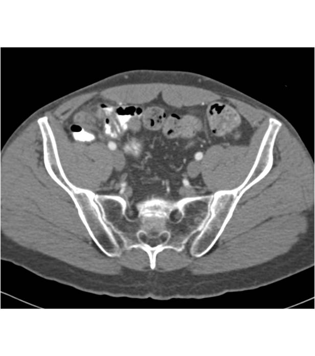 Acute Appendicitis - CTisus CT Scan