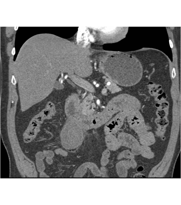 Mesenteric Hematoma off Duodenum - CTisus CT Scan