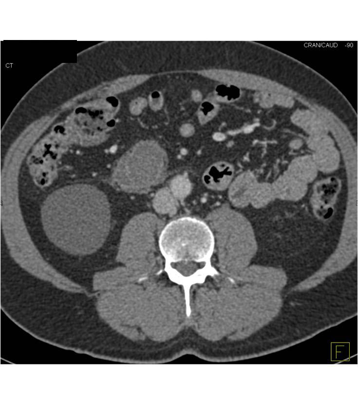 Carcinoid Tumor with Distant Metastases - CTisus CT Scan